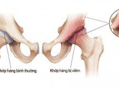 Tập vật lý trị liệu sau phẩu thuật thay khớp háng